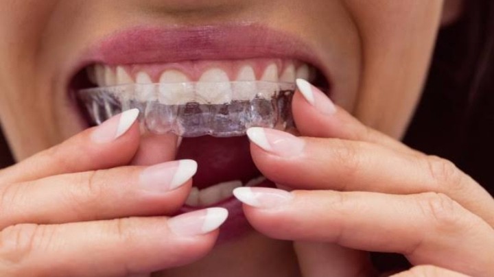 Comparison between Invisalign and Braces